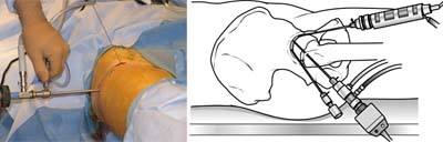 arthroscopy